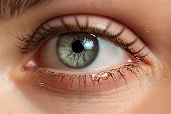 红眼病的护理措施是有哪些