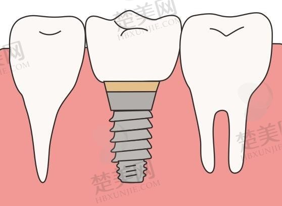 昆明华美美莱口腔：单颗种植牙价格3680元起，半口种植牙4.8万元起