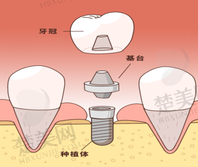 天津天医联合口腔医院：以色列雅植种植牙一颗4499元，正雅日夜版牙套矫正5099元