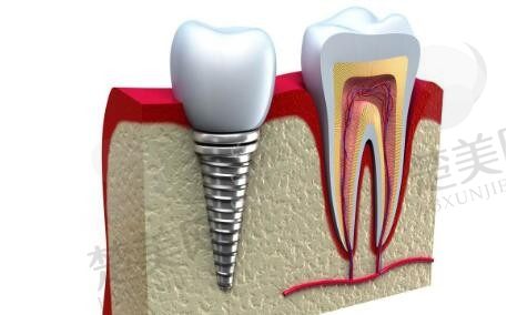 绍兴金柯桥医院（口腔科）发布非常新种植牙价格，国产百康特种植牙一颗起价3818元！