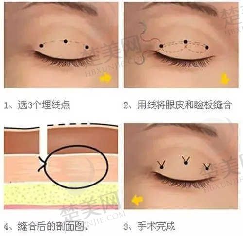 北京丰联丽格医疗美容医院双眼皮修复贵不贵？师丽丽双眼皮修复价格18800-38500元左右！