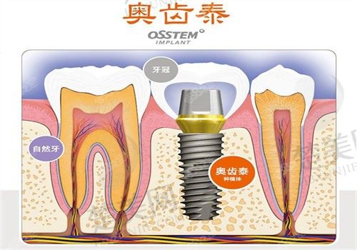 巴中华医口腔杨建韩国进口全瓷3980元/颗，种植牙价格详情地址电话