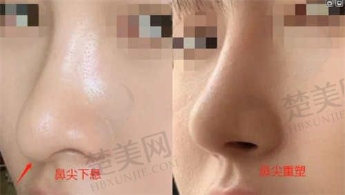 郴州唯美医疗美容欧阳春医生鼻修复12800起步，项目很齐全，其他项目价格也在这