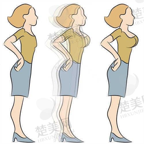 景德镇华瑞整形医院隆胸修复170000元起，包含假体隆胸