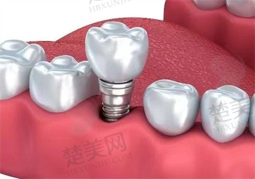 郑州南区口腔医院怎么样？正规医保可否报销？看牙价格及口碑评价深度解析