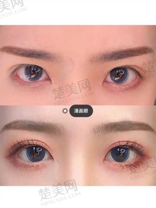 南京青春之泉整形医院割双眼皮20000元起，正规医生团队