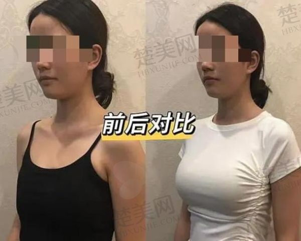 杭州艺星万连壮医生隆胸技术怎么样?技术全面/审美在线/手感好/性价比高