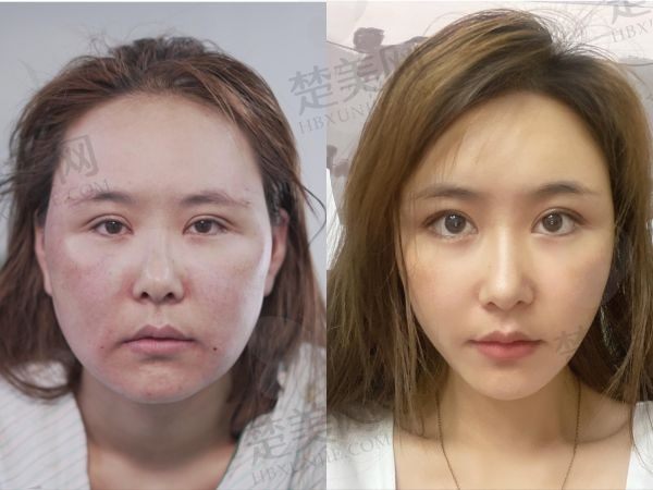 广州军美王世虎小V脸21800元起，风格自然审美靠谱性价比高