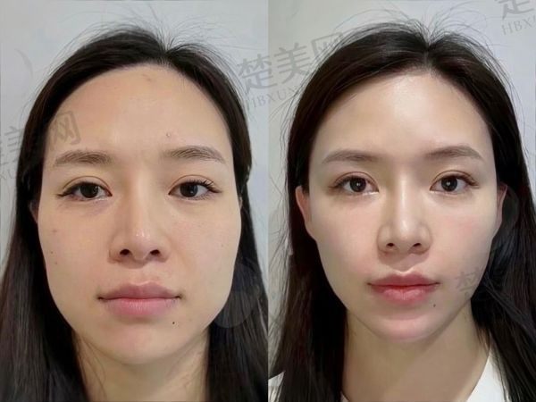北京加减美黄寅守面部提升5万起，减龄成效显著维持时间久顾客满意度高