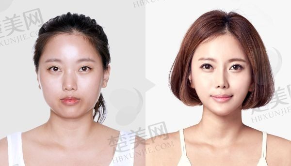 重庆松山肖林下颌角双侧截骨34200元起，风格自然顾客反馈特别好