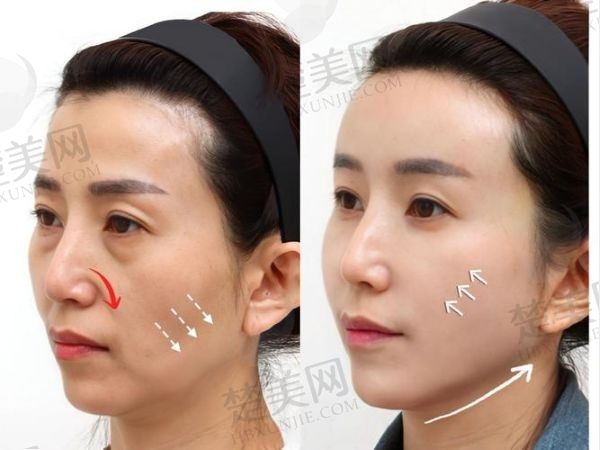 成都素美李建钢无痕筋膜提升2w起，减龄成效明显成功实例多比较可靠