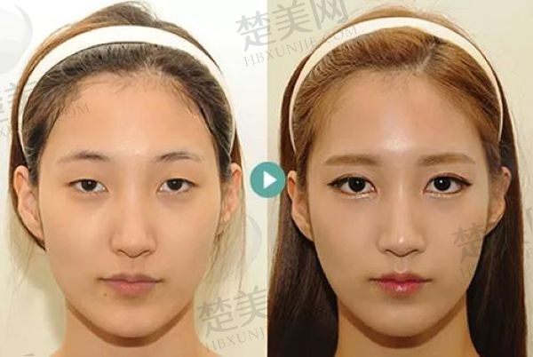 北京魏志香双眼皮修复怎么样？医生简介+技术优势+真实口碑+价格揭晓