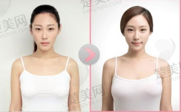 北京知音李奇军脂肪丰胸35800元起，术后饱满挺拔手感好风格自然