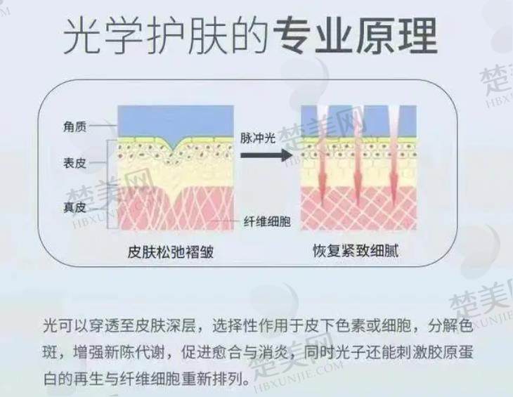 光子嫩肤.jpg