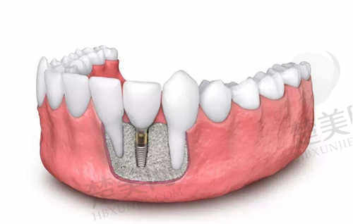 武汉牙达人口腔医院的种植牙