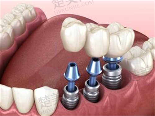 武汉牙达人口腔医院的种植牙