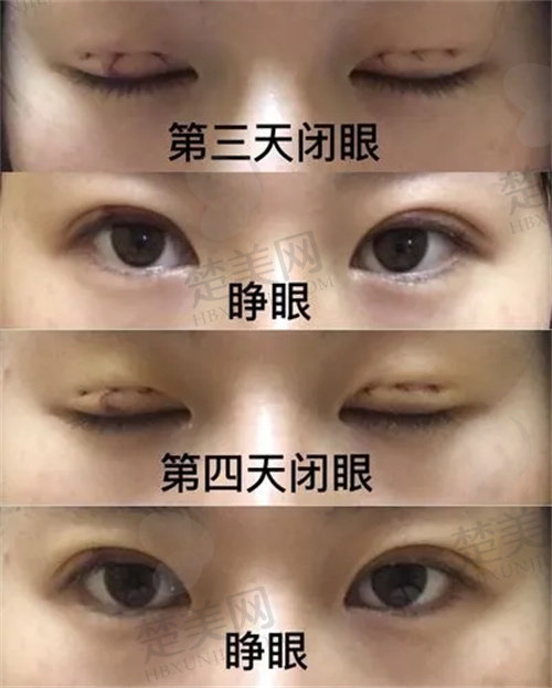 郑州美菲斯医疗美容医院双眼皮手术<span style=