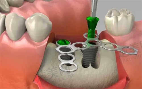 新疆乌鲁木齐美奥口腔种植牙