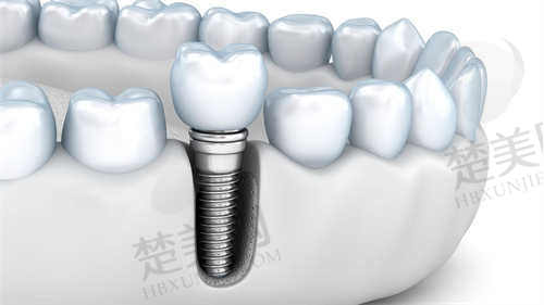 萍乡牙佰年口腔医院种植牙
