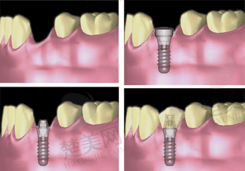 种植牙图9_new.png