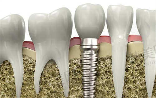 常州北极星口腔罗新宇医生瑞士ITI种植牙价格12800元起