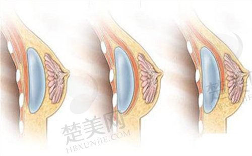 北京叶子整形美容医院胸部假体取出术前注意事项