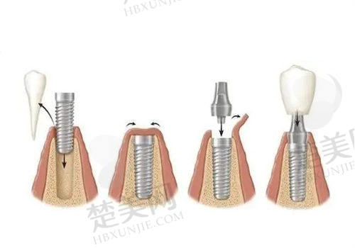 巴中华医口腔医院种植牙价格