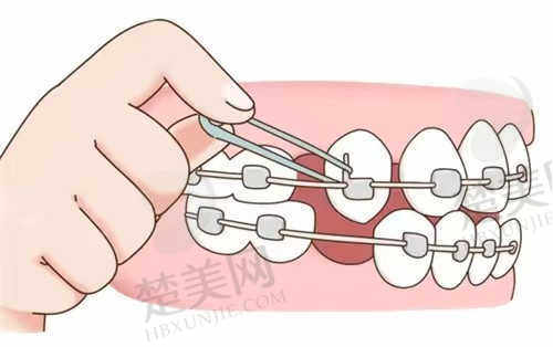 南阳牙博士口腔医院时代天使牙齿矫正价格