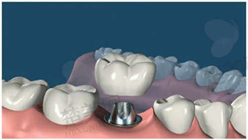 桂林春天口腔门诊部种植牙怎么样