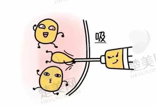 芳华整形医院特色技术——360°环形吸脂技术