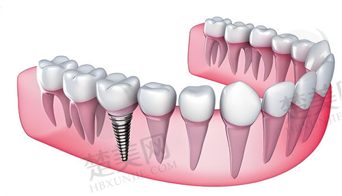 株洲中诺口腔医院种植牙怎么样