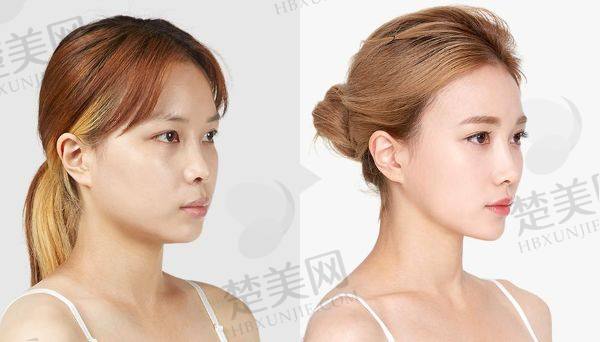 杭州艺星张龙院长肋软骨皮质隆鼻价格