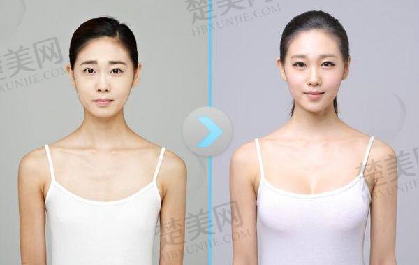 上海美莱整形医院价格表