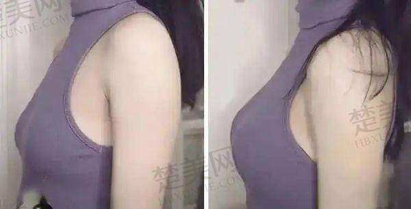 上海美莱整形医院隆胸怎么样