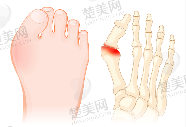 北京做大脚骨手术多少钱