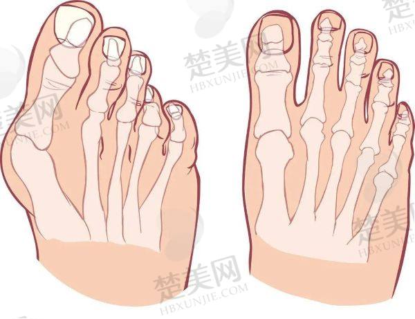 北京治疗拇外翻多少钱