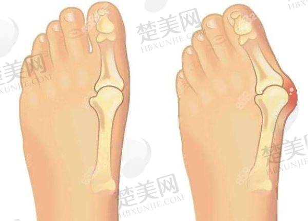 北京做大脚骨手术哪家医院好