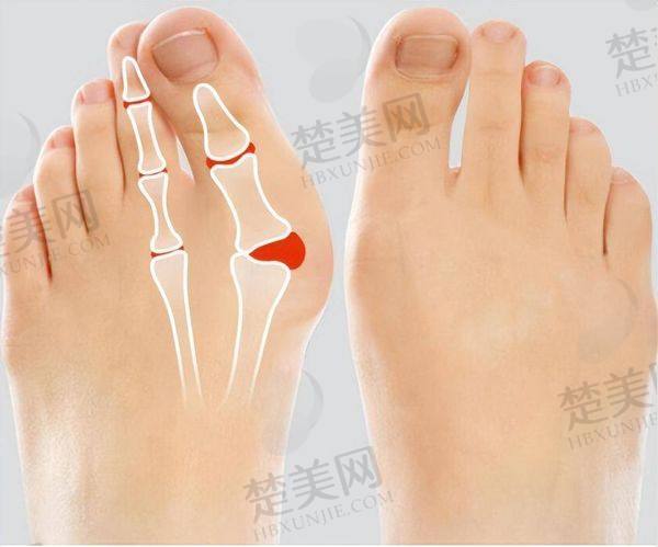 北京圣嘉新苏敬达做大脚骨拇外翻怎么样
