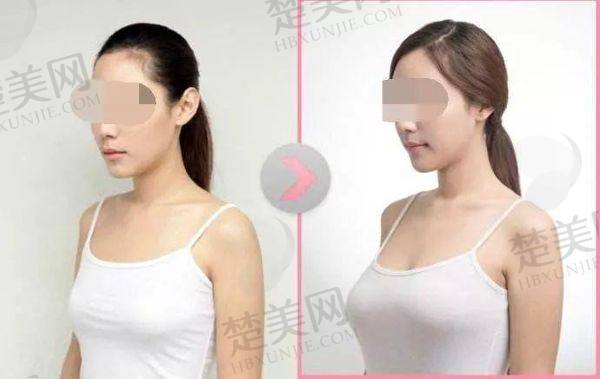 上海隆胸哪家医院做的比较好