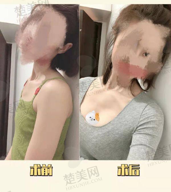 上海隆胸手术价格全览