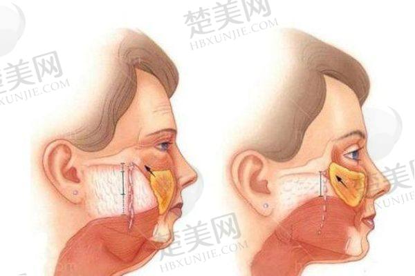 高亚东做拉皮成效好吗