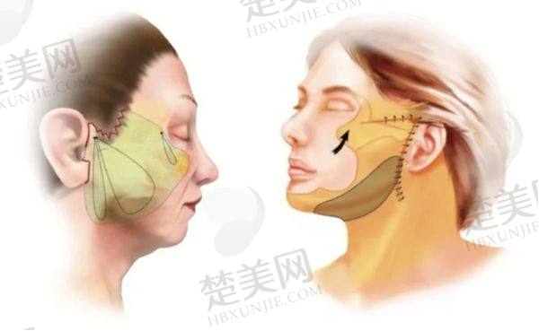 北京加减美黄寅守做拉皮需要排队吗