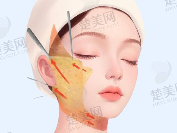北京加减美黄寅守做拉皮费用