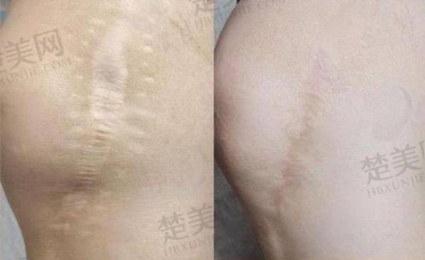 上海建桥医院疤痕科口碑评价