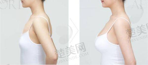 上海隆胸哪家医院好