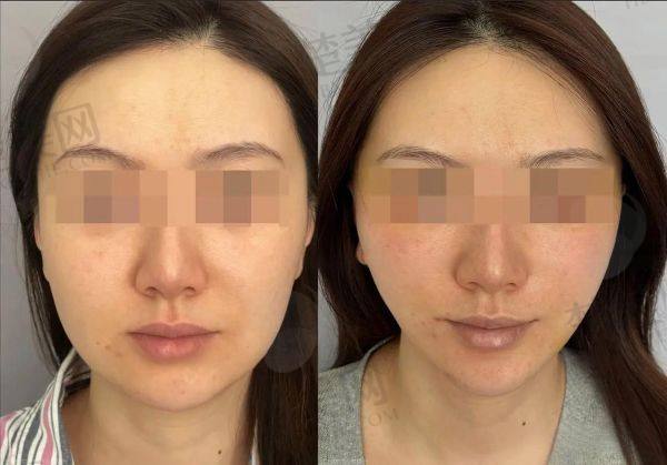 北京加减美黄寅守面部提升多少钱