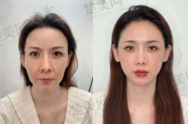 北京加减美黄寅守面部提升技术优势