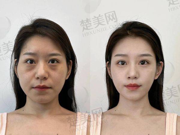 北京加减美黄寅守面部提升口碑