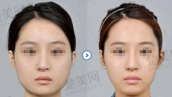 重庆松山肖林下颌角双侧截骨怎么样