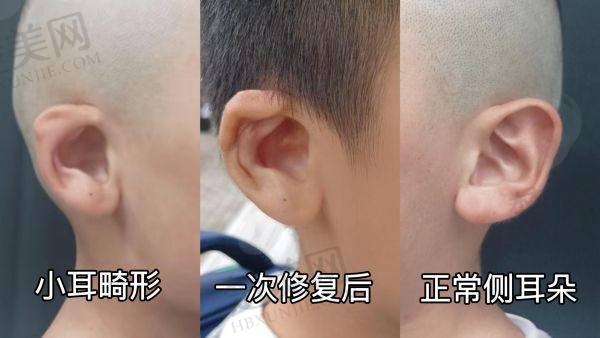 国内小耳畸形医院排名前十